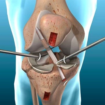 Artroscopia no joelho